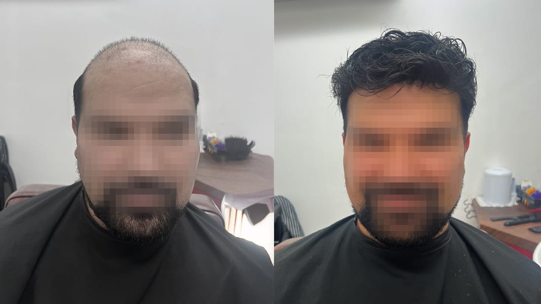 Front view before an after shot of man with improved hair