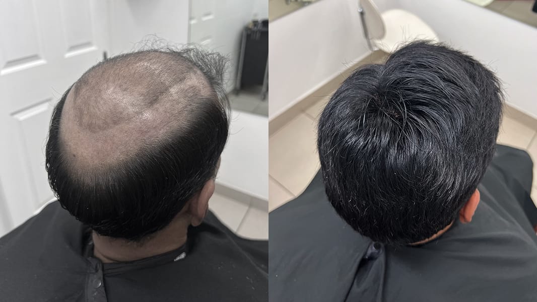Top view before an after shot of man with improved hair