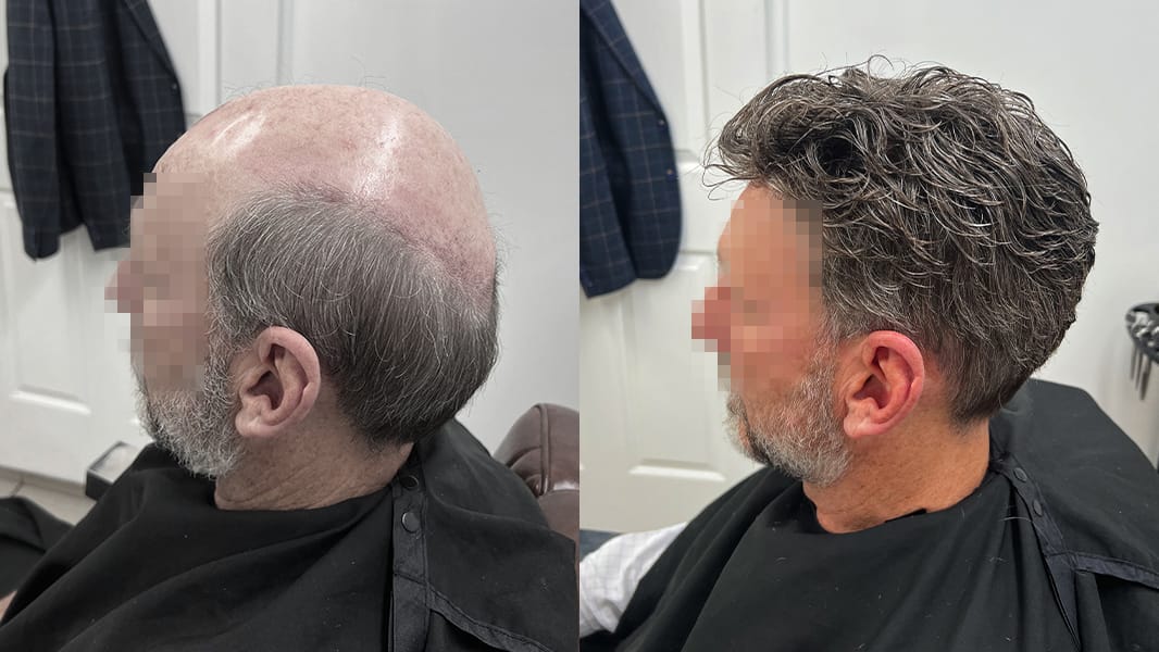 Side view before an after shot of man with improved hair